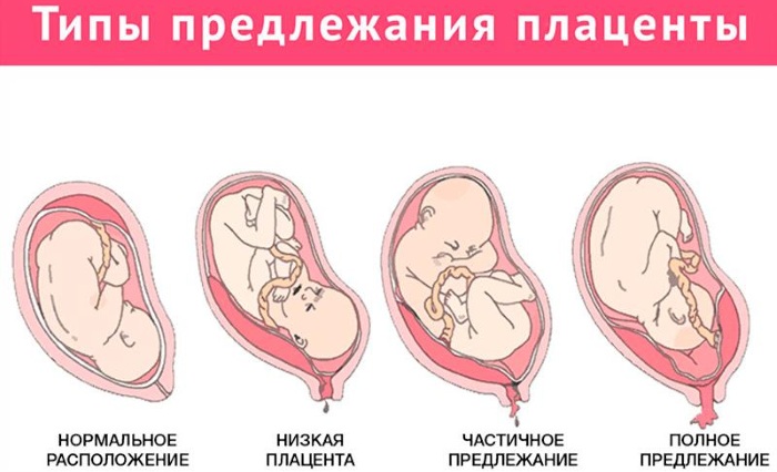 Тазовое предлежание плода презентация