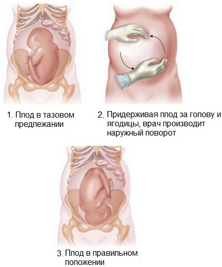 Головное предлежание плода на 20-30 неделе беременности