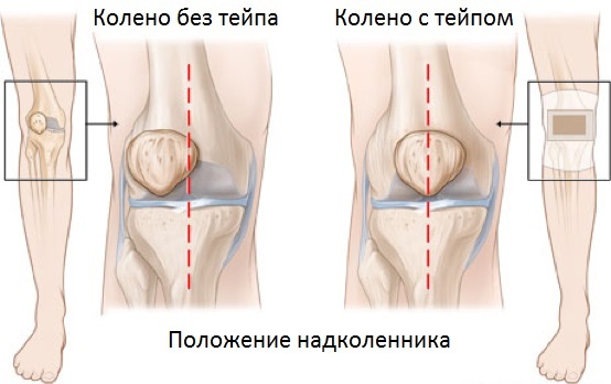 Тейп на колено. Как наложить пошагово, схема для боковой связки, мениска