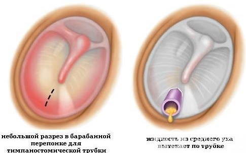 Воспаление среднего уха. Лечение в домашних условиях, препараты, симптомы у взрослых