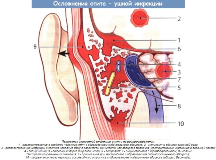 Воспаление среднего уха. Лечение в домашних условиях, препараты, симптомы у взрослых