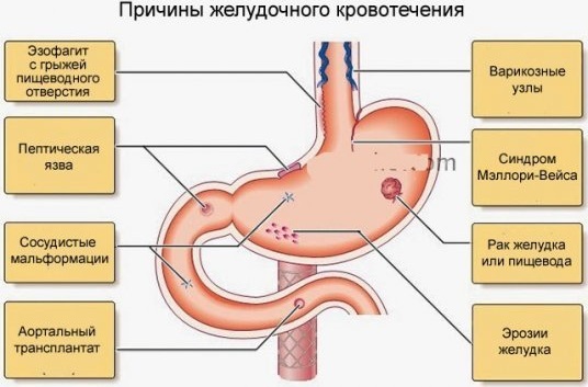 Желудочное кровотечение. Симптомы у взрослых, причины, лечение