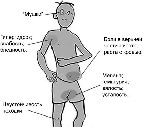 Желудочное кровотечение. Симптомы у взрослых, причины, лечение