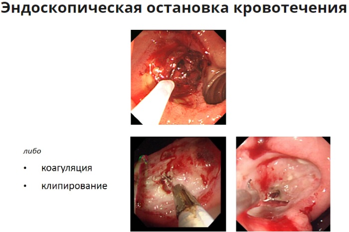 Желудочное кровотечение. Симптомы у взрослых, причины, лечение