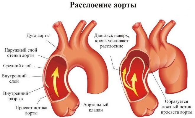 Аорта у человека. Где находится, начинается, отходит, анатомия