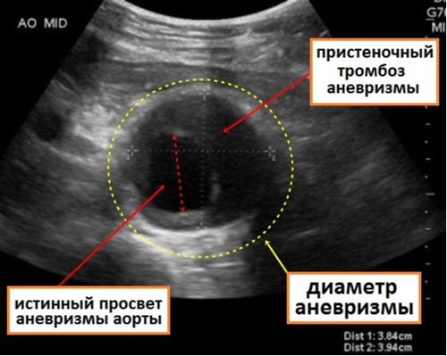 Аорта у человека. Где находится, начинается, отходит, анатомия