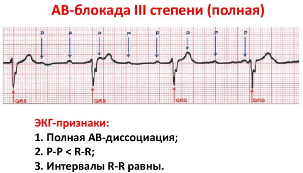 Ав блокады на экг картинки