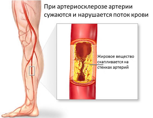 Боли в мышцах ног и рук. Причины и лечение, медикаменты