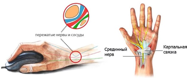 Боли в запястье правой руки. Причины и лечение