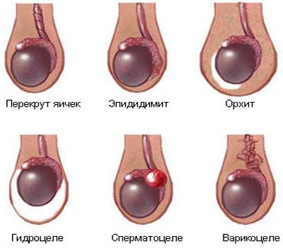 Болит яичко справа, слева у мужчин, тянет низ живота. Причины, лечение
