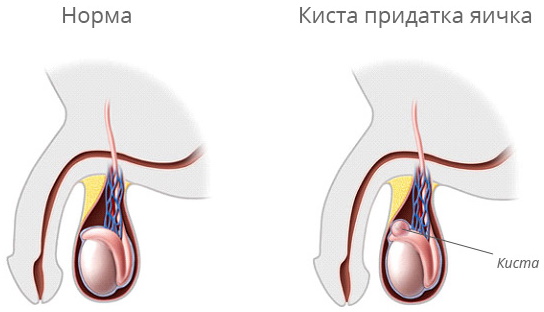 Болит яичко справа, слева у мужчин, тянет низ живота. Причины, лечение