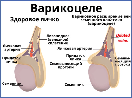 Болит яичко справа, слева у мужчин, тянет низ живота. Причины, лечение