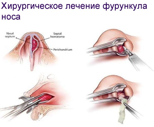 Чирей в носу. Как лечить мазью, антибиотик, народные средства