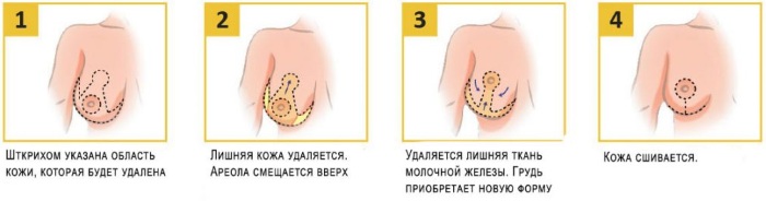 Гигантомастия у женщин. Фото, что это такое