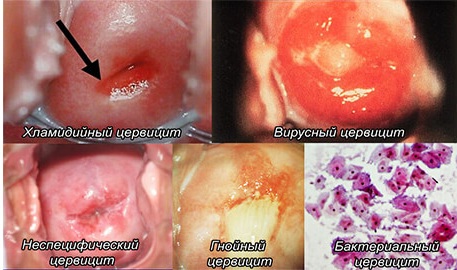 Хронический церцевит шейки матки. Лечение травами, средствами