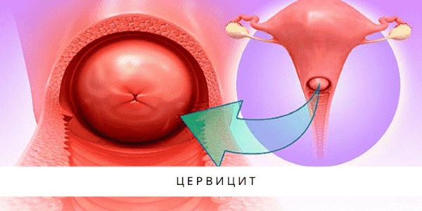 Хронический церцевит шейки матки. Лечение травами, средствами