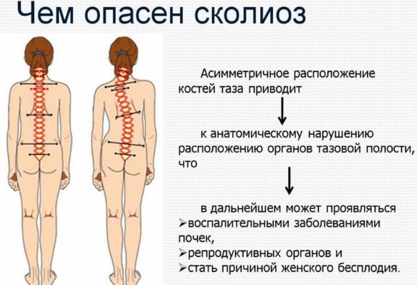 Искривление позвоночника у подростков. Лечение