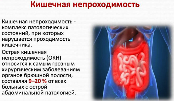 Колит внизу живота слева у женщин, мужчин, при беременности. Причины