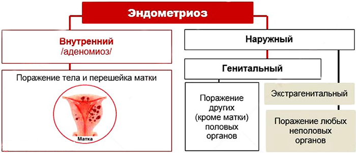 Колит внизу живота слева у женщин, мужчин, при беременности. Причины