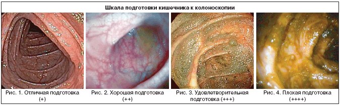 Колоноскопия под седацией. Что это такое, цена, отзывы