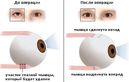 Косоглазие у детей. Фото, что это такое страбизм, причины, лечение