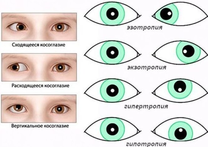 Косоглазие у детей. Фото, что это такое страбизм, причины, лечение