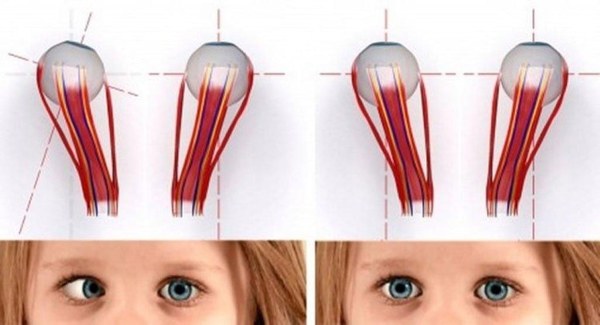 Косоглазие у детей. Фото, что это такое страбизм, причины, лечение