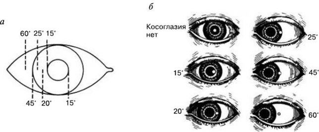 Косоглазие у детей. Фото, что это такое страбизм, причины, лечение