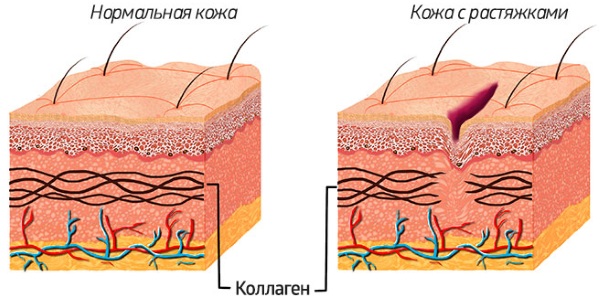 Крем от растяжек для подростков. Какой лучше, отзывы