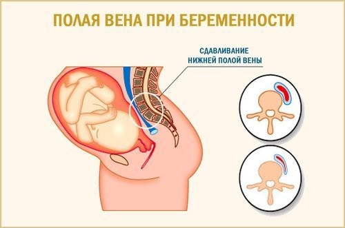 Нижняя полая вена. Анатомия, где находится, функции, заболевания