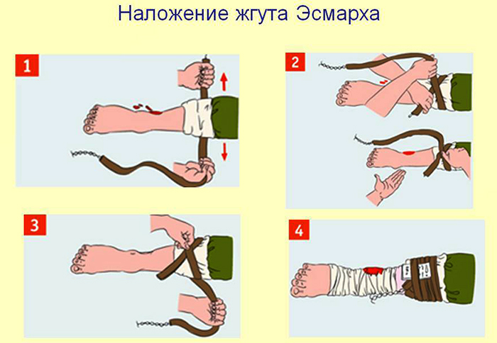 Остановка артериального кровотечения. Алгоритм жгутом или закруткой, пальцевым прижатием