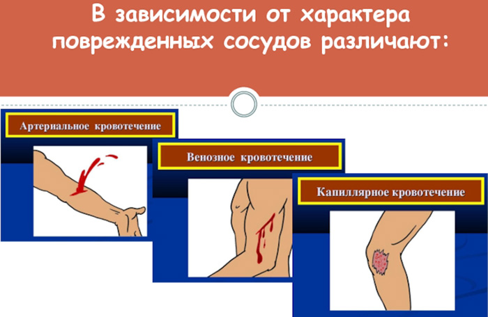 Остановка венозного кровотечения. Что необходимо, способы, алгоритм