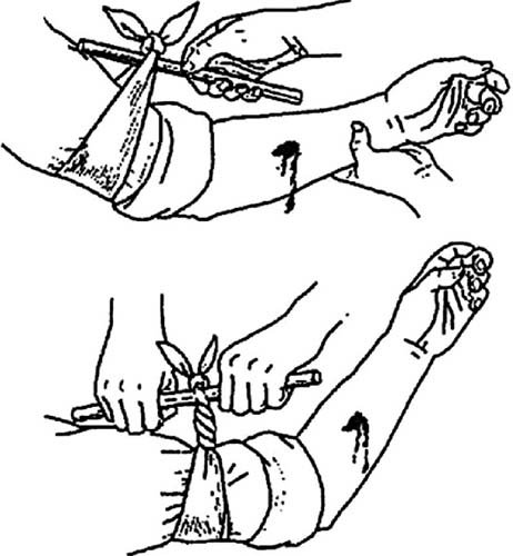 Остановка венозного кровотечения. Что необходимо, способы, алгоритм