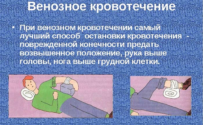 Остановка венозного кровотечения. Что необходимо, способы, алгоритм