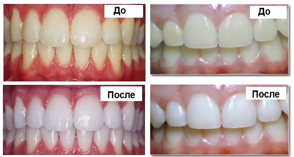 Отбеливание зубов лазером. Цена, фото, отзывы