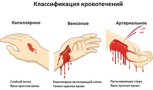 Пальцевое прижатие бедренной артерии. Где, как выполняется, алгоритм