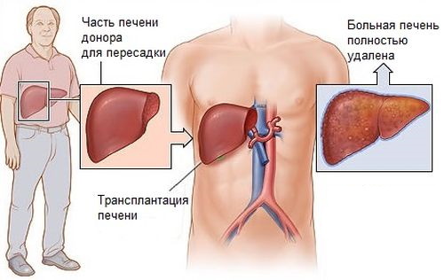 Пересадка печени. Цена трансплантации в России