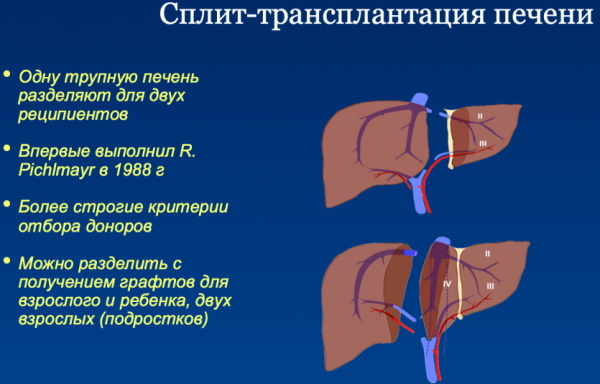 Пересадка печени. Цена трансплантации в России