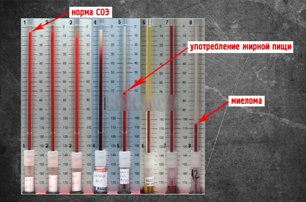 Повышена СОЯ в крови у взрослого. Причины и лечение