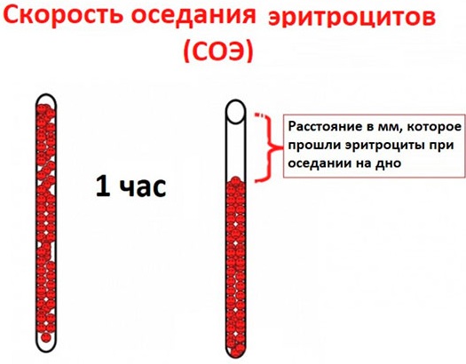 Повышена СОЯ в крови у взрослого. Причины и лечение