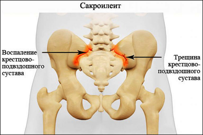 Сакроилеит крестцово-подвздошного сочленения, сустава