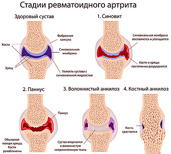 Сакроилеит крестцово-подвздошного сочленения, сустава