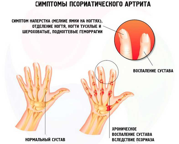 Сакроилеит крестцово-подвздошного сочленения, сустава