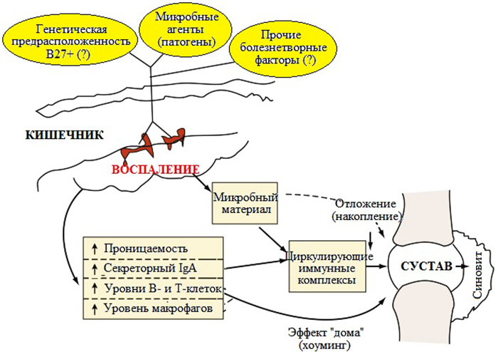 Сакроилеит крестцово-подвздошного сочленения, сустава