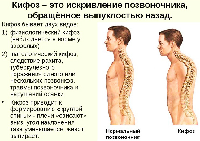 Сакроилеит крестцово-подвздошного сочленения, сустава