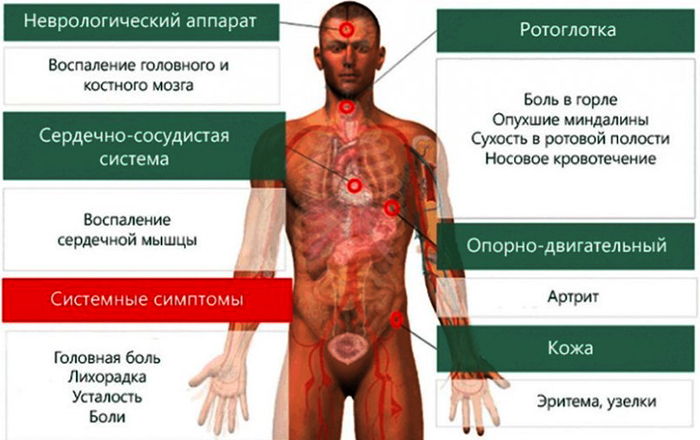 Сакроилеит крестцово-подвздошного сочленения, сустава