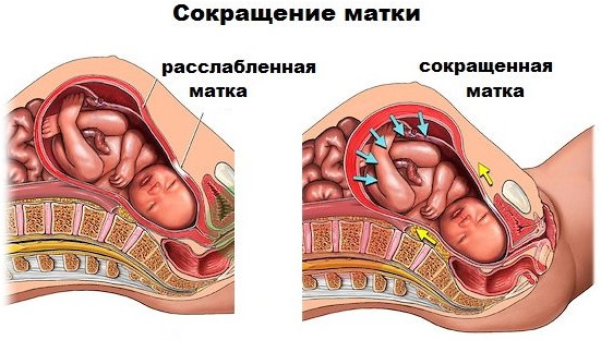 Схватки Брэкстона-Хикса (Хиггса, Хиггинса). Ощущения, со скольки недель