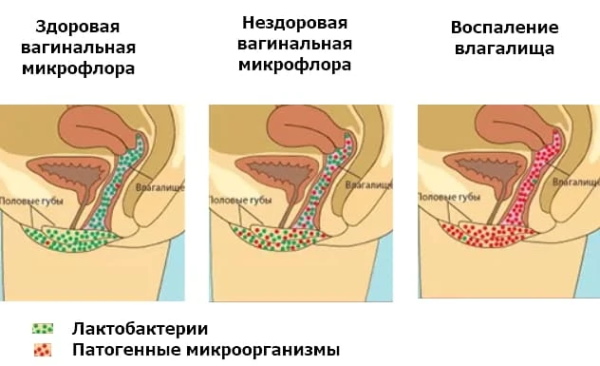 Слизистые выделения при беременности: желтые, белые, коричневые, зеленые