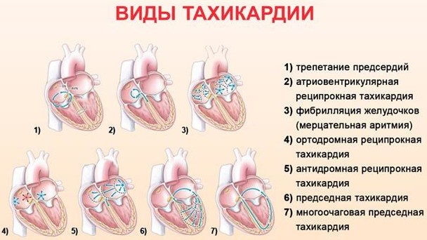 Тахикардия при беременности в 1-2-3 триместре. Лечение