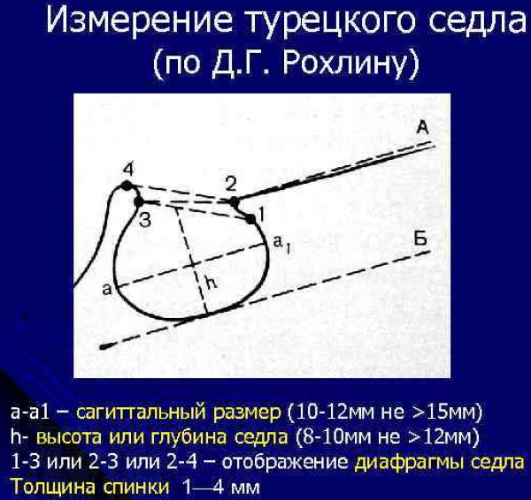 Турецкое седло в голове. Что это такое, за что отвечает, где находится, как лечить